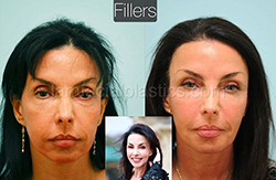 Fillers Before & After
