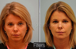 Fillers Before & After