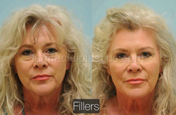 Fillers Before & After