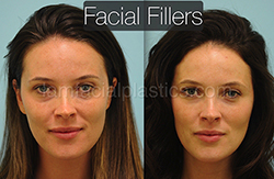 Fillers Before & After