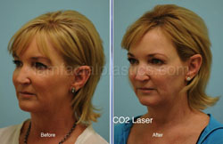 Laser Skin Resurfacing Before & After