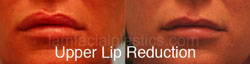 Lip Reduction Before & After