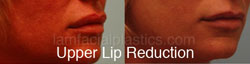 Lip Reduction Before & After