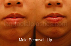 Mole Removal Before & After