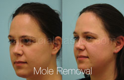 Mole Removal Before & After