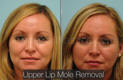 Mole Removal Before & After