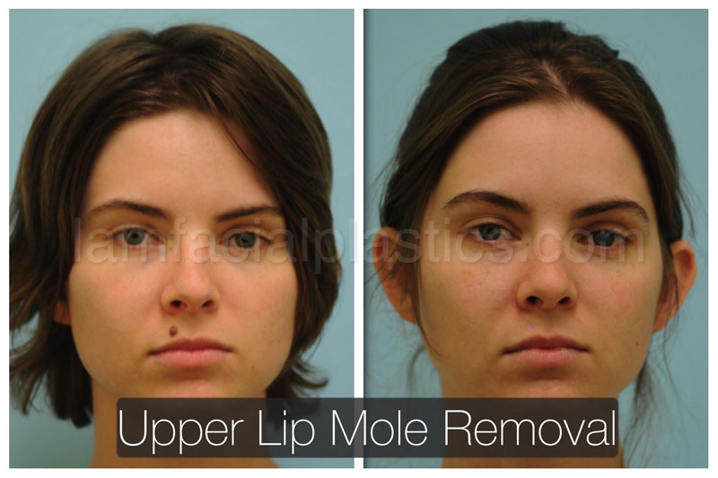 For Additional Mole Removal Photos Please Visit Our Gallery