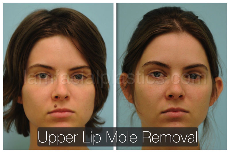 Mole Removal Dallas Plastic Surgery Procedures Plano TX