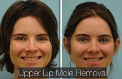 Mole Removal Before & After