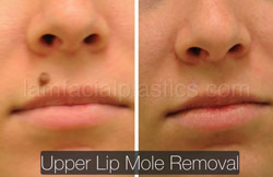 Mole Removal Before & After