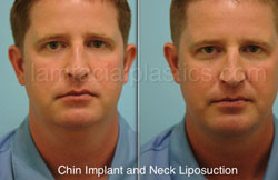 Neck Liposuction Before & After Dallas & Plano, TX