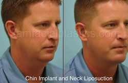 Neck Liposuction Before & After Dallas & Plano, TX