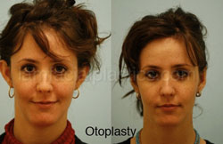 Otoplasty Surgery Results Dallas Texas
