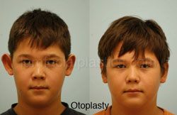 Otoplasty Surgery Results Dallas Texas