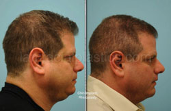 Otoplasty Surgery Results Dallas Texas