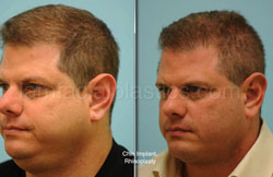 Otoplasty Surgery Results Dallas Texas