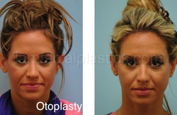 Otoplasty Surgery Results Dallas Texas