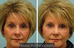 Rhinoplasty Before and After Plano, TX