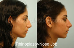 Rhinoplasty Before and After Plano, TX