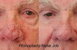 Rhinoplasty Before and After Plano, TX