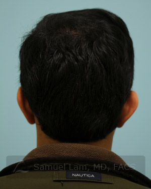 Otoplasty (Cosmetic Ear Reshaping)