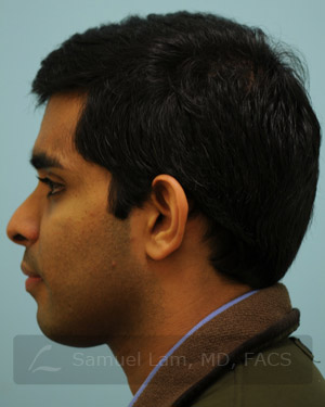 Otoplasty (Cosmetic Ear Reshaping)