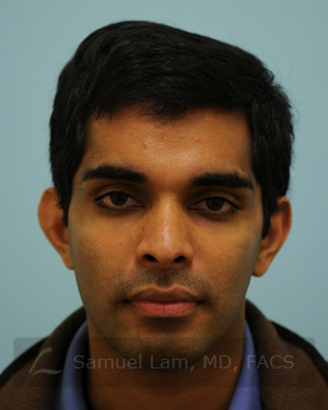 Otoplasty (Cosmetic Ear Reshaping)