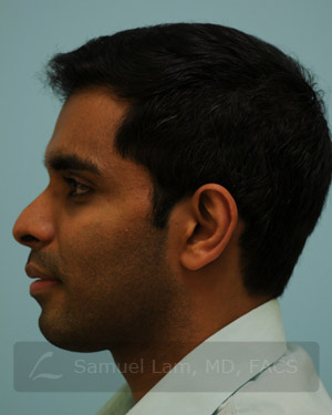 Otoplasty (Cosmetic Ear Reshaping)