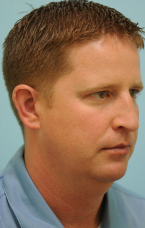Chin Augmentation