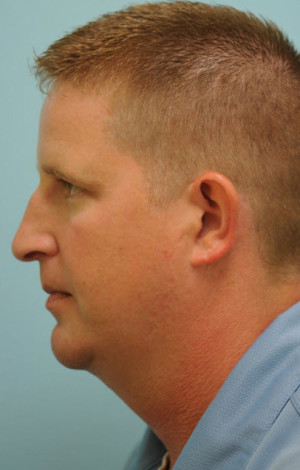 Chin Augmentation
