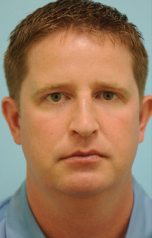 Chin Augmentation