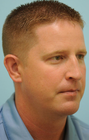 Chin Augmentation