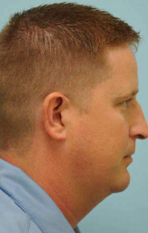 Chin Augmentation