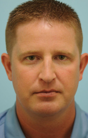 Chin Augmentation