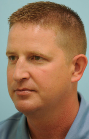 Chin Augmentation