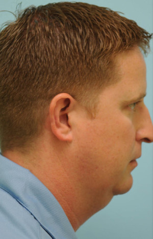 Chin Augmentation