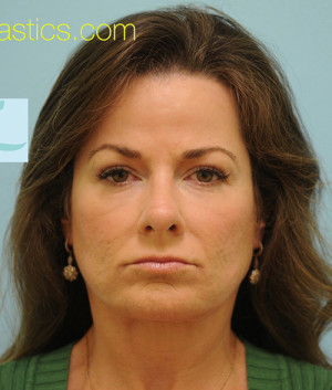 Primary Facial Fat Transfer