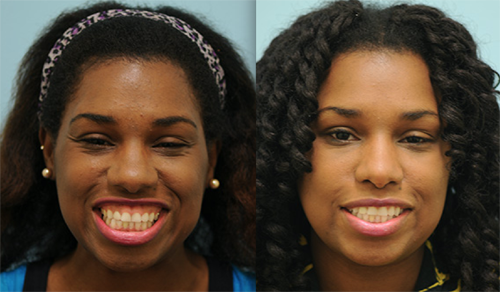 Botox for Gummy Smile