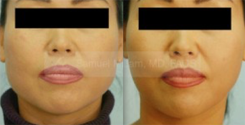 Botox Jaw Reduction Before & After