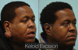 Keloid Removal Before & After