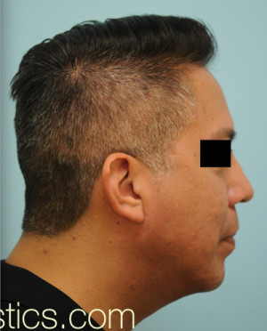 Chin Augmentation
