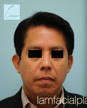 Chin Augmentation