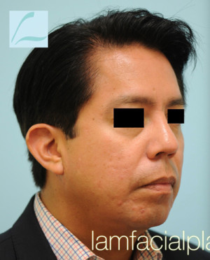 Chin Augmentation