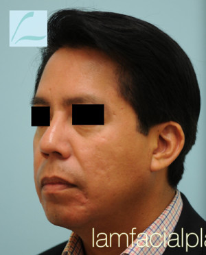 Chin Augmentation