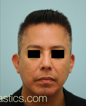Chin Augmentation