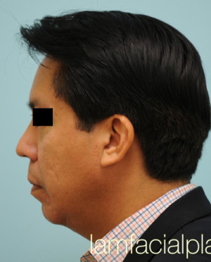 Chin Augmentation
