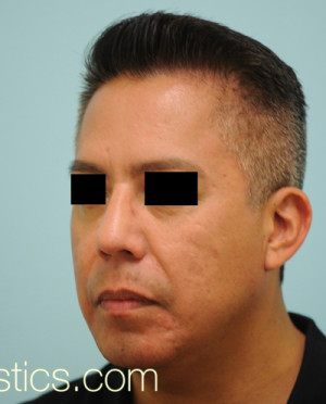 Chin Augmentation