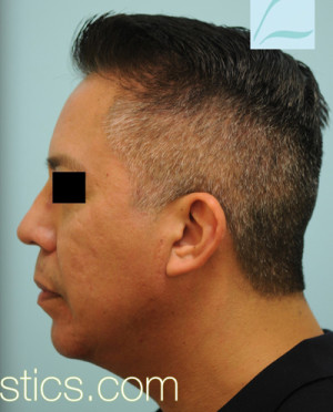 Chin Augmentation
