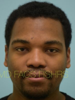 Rhinoplasty-Nose Job