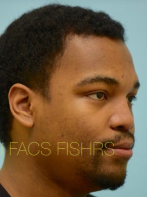 Rhinoplasty-Nose Job